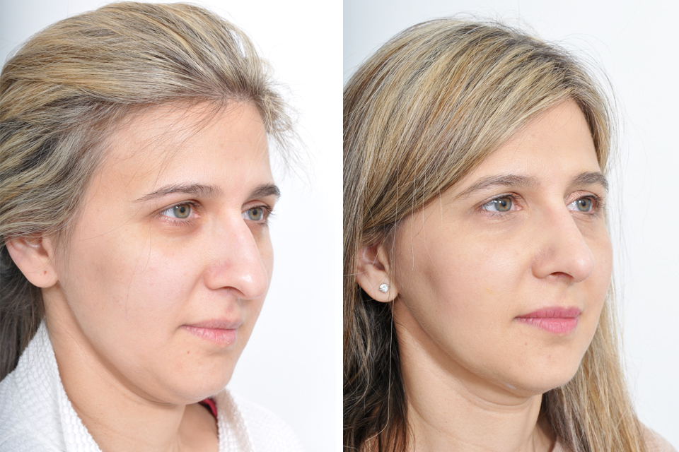 A Beginners Guide to Rhinoplasty.