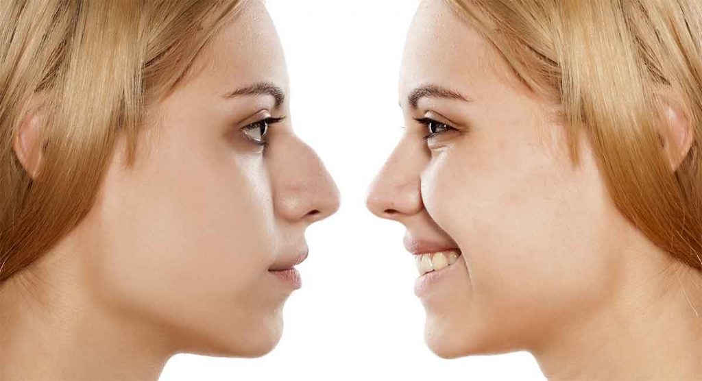 A Scar less Nose Job - Open Vs Closed Rhinoplasty.