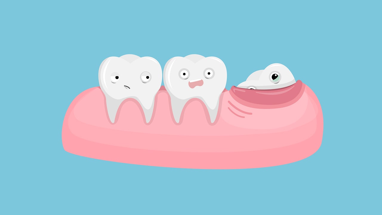 Why should you get Wisdom Teeth Removed